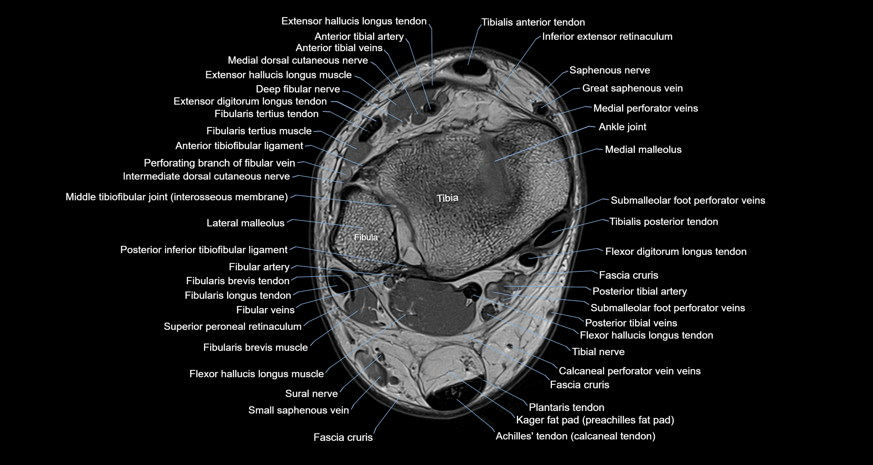 Ankle axial anatomy 3T MRI images -img-10001-00011.webp